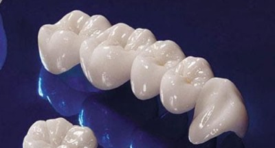Răng sứ thẩm mỹ là gì? Răng sứ thẩm mỹ là loại răng được tạo hình có màu sắc, hình dáng giống như răng thật